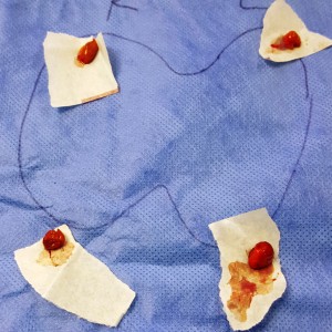 4 parathyroids enlarged by renal dialysis